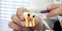 endodontia-tratamento-de-canal